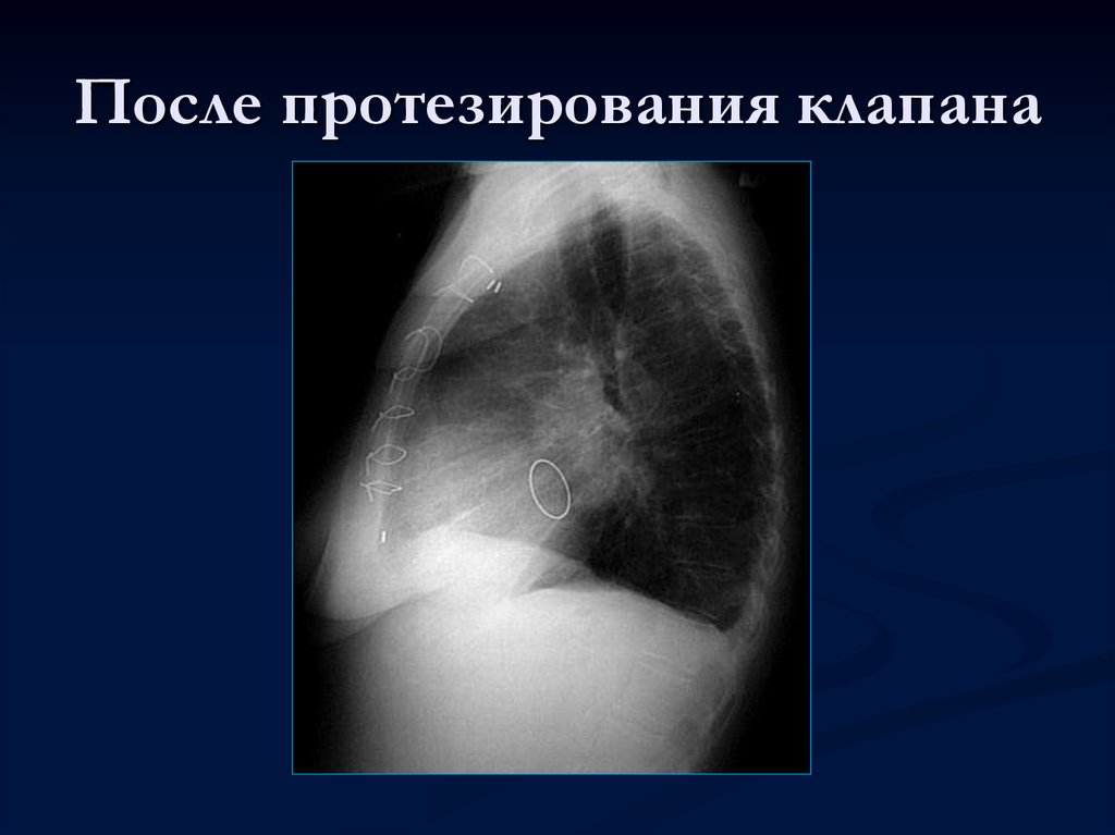 Митральный клапан после операции. Искусственный аортальный клапан рентген. Аортальный клапан сердца рентген. Протезы клапанов сердца на рентгене. Искусственный клапан сердца рентген.
