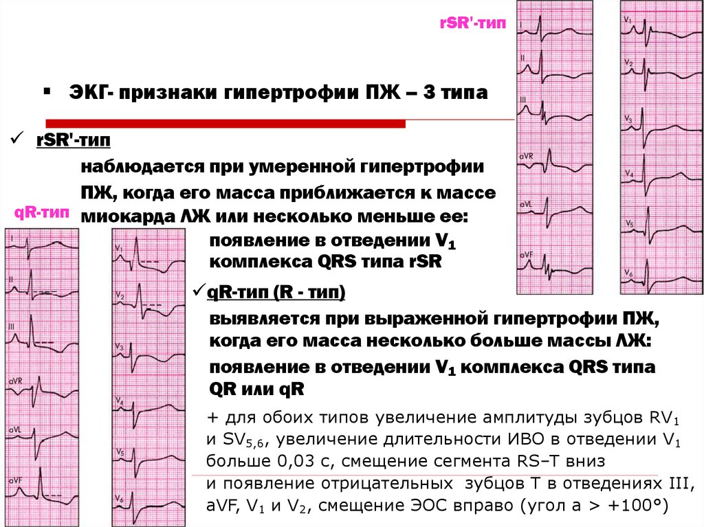 Глж на экг что это значит. R Тип гипертрофии правого желудочка на ЭКГ. R - Тип гипертрофии левого желудочка на ЭКГ. Гипертрофия правого желудочка на ЭКГ RSR Тип. ЭКГ при гипертрофии пж.