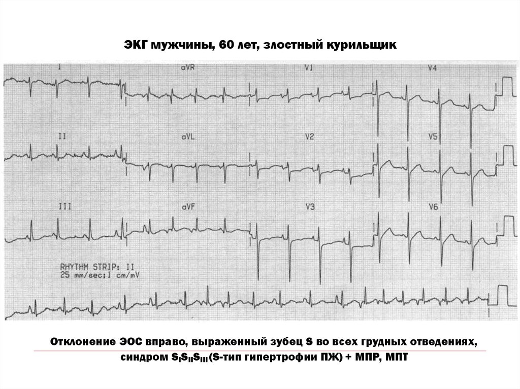 Типы экг. Хроническое легочное сердце ЭКГ. S Тип гипертрофии правого желудочка на ЭКГ. ЭКГ при первичной легочной гипертензии. ЭКГ при хроническом легочном сердце.