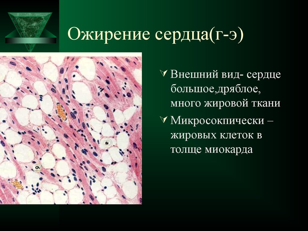 Дистрофия миокарда. Ожирение сердца исход патанатомия. Ожирение миокарда макропрепарат. Ожирение сердца патанатомия макропрепарат. Ожирение сердца микропрепарат.