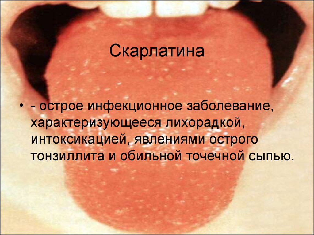 Температура тела в слизистых оболочках. Стрептококковая скарлатина. Сыпь на языке при скарлатине.