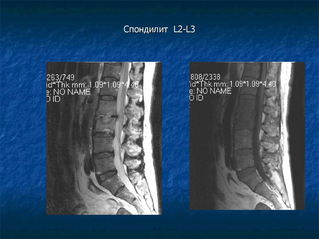 Спондилит. Спондилит позвонков l3 l4. Асептический спондилит l2-s1. Неспецифический спондилит l5.