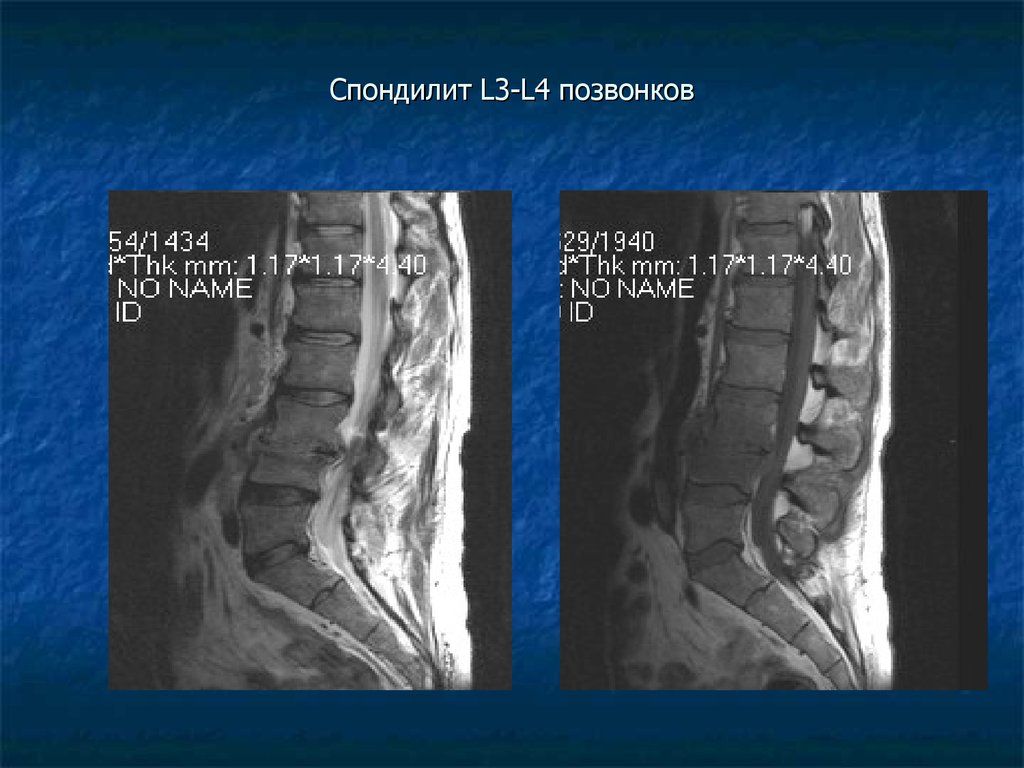 Спондилит это. Спондилит l4 l5 позвонков. Спондилит позвонков l3 l4. Спондилит l4-l5. Спондилит позвоночника l4 l5.