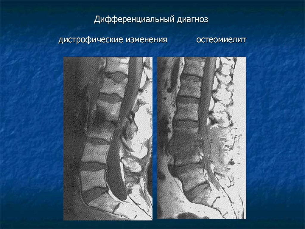 Дистрофические изменения. Остеомиелит позвоночника на кт. Остеомиелит позвонков кт. Остеомиелит позвонков рентген. Остеомиелит позвоночника мрт.