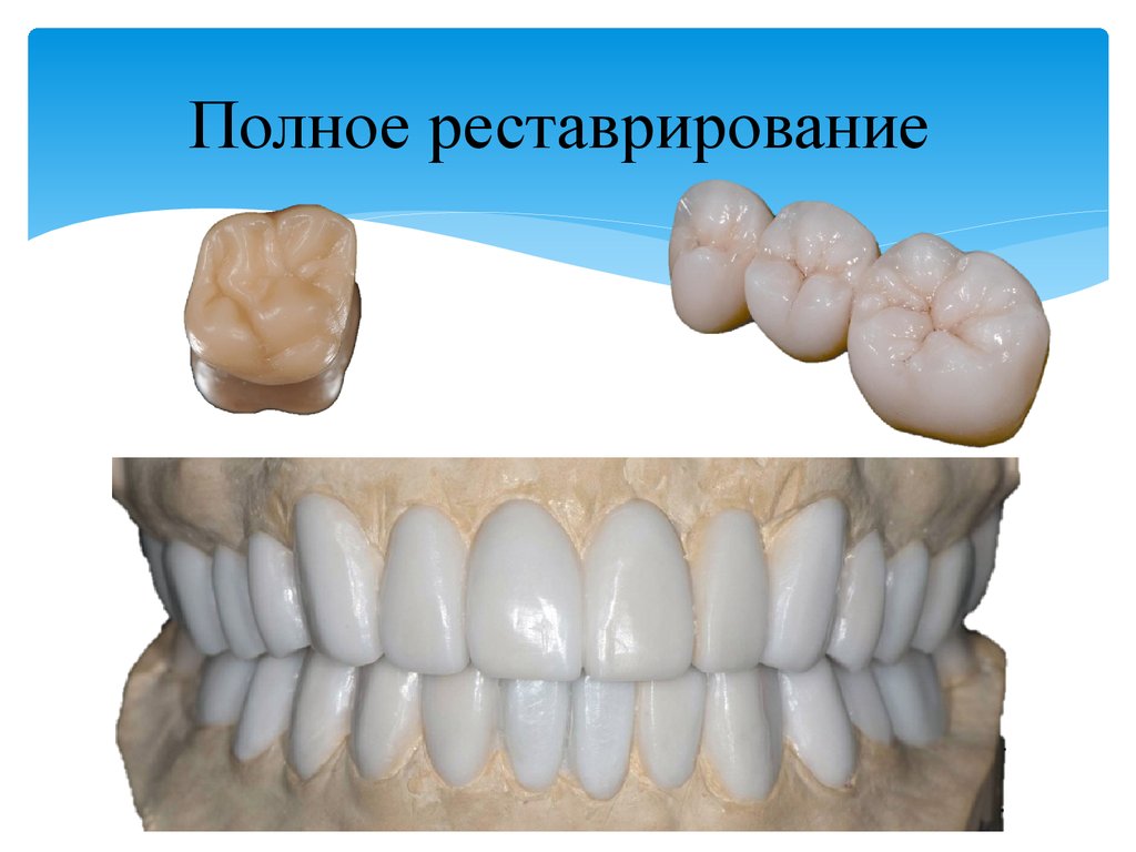 Презентация безметалловая керамика