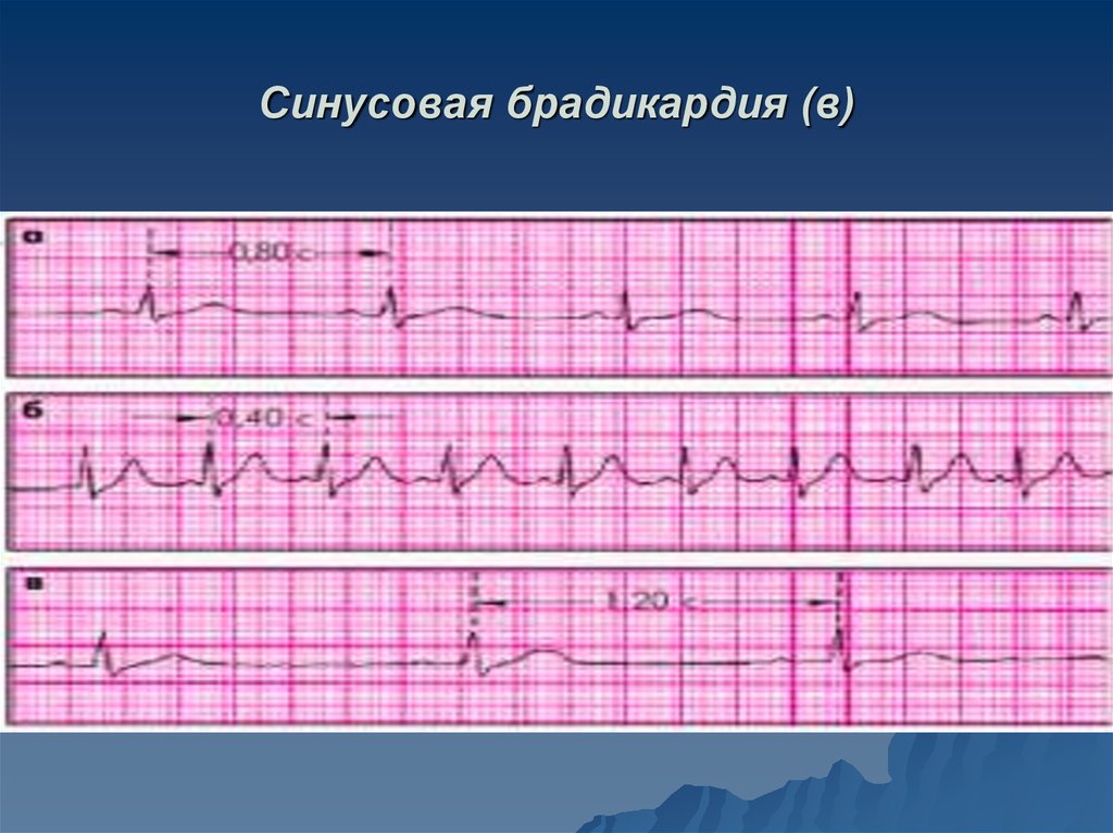 Синусовая брадикардия. Синусовая брадикардия на ЭКГ. ЭКГ при синусовой тахикардии синусовой брадикардии. Синусовая брадикардия ЭКГ признаки. ЭКГ критерии синусовой брадикардии.