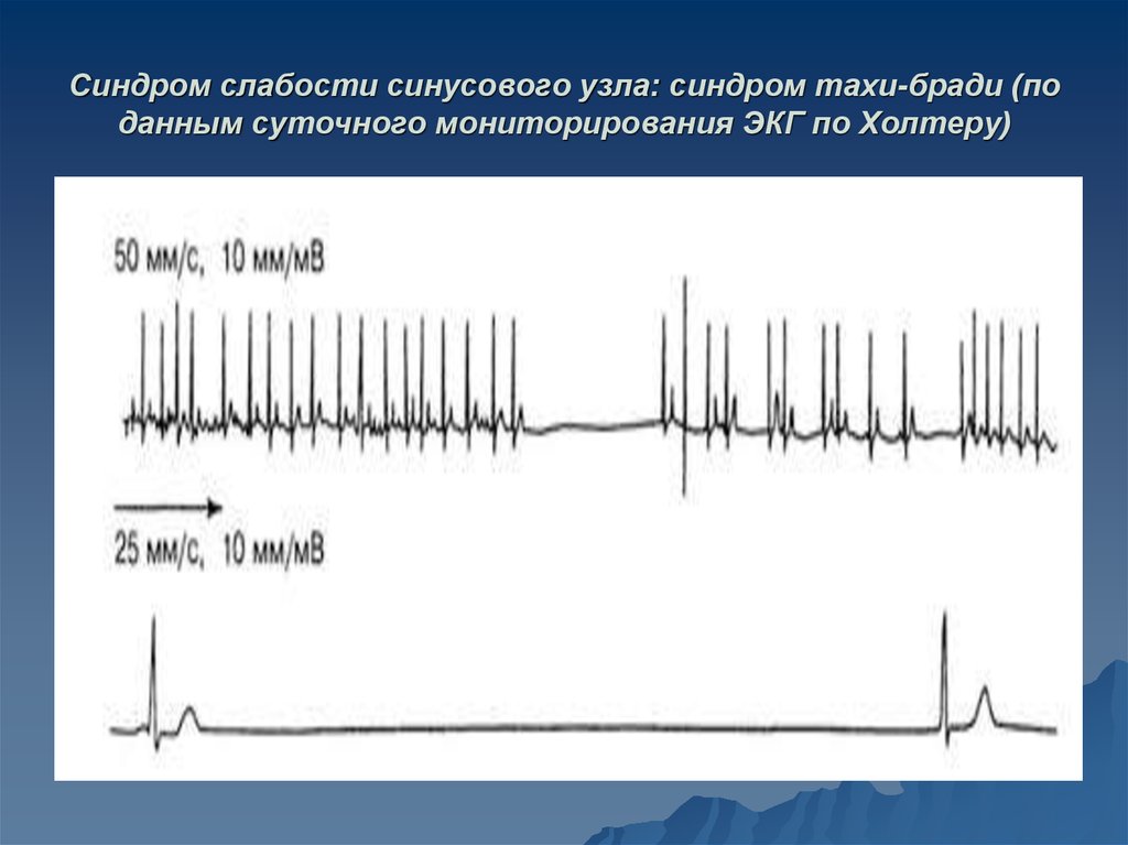 Карта вызова слабость синусового узла