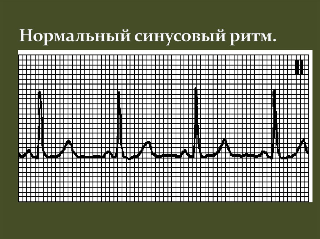 Синусовая брадикардия на экг. Синусовая нормокардия. Синусовая нормокардия сердца что это. Ритм синусовая нормокардия. Нормальный синусовый ритм.