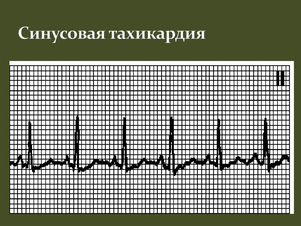 Тахикардия на экг