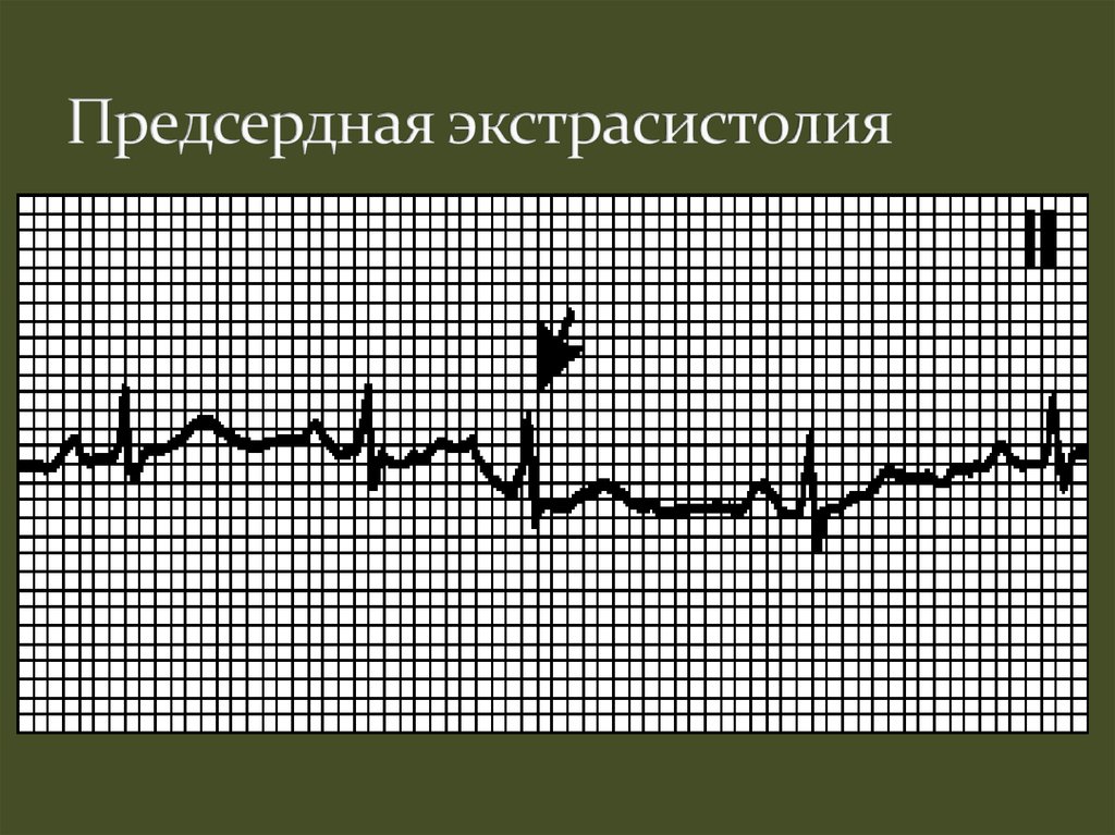 Что такое экстрасистолия сердца. Предсердная экстрасистолия на ЭКГ. ЭКГ при предсердной экстрасистолии. Одиночная предсердная экстрасистола на ЭКГ. Предсерднаяэкстрасистола.