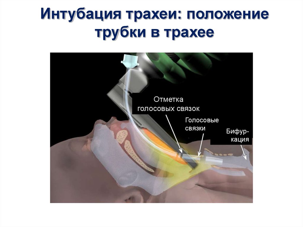 Интубация трахеи презентация