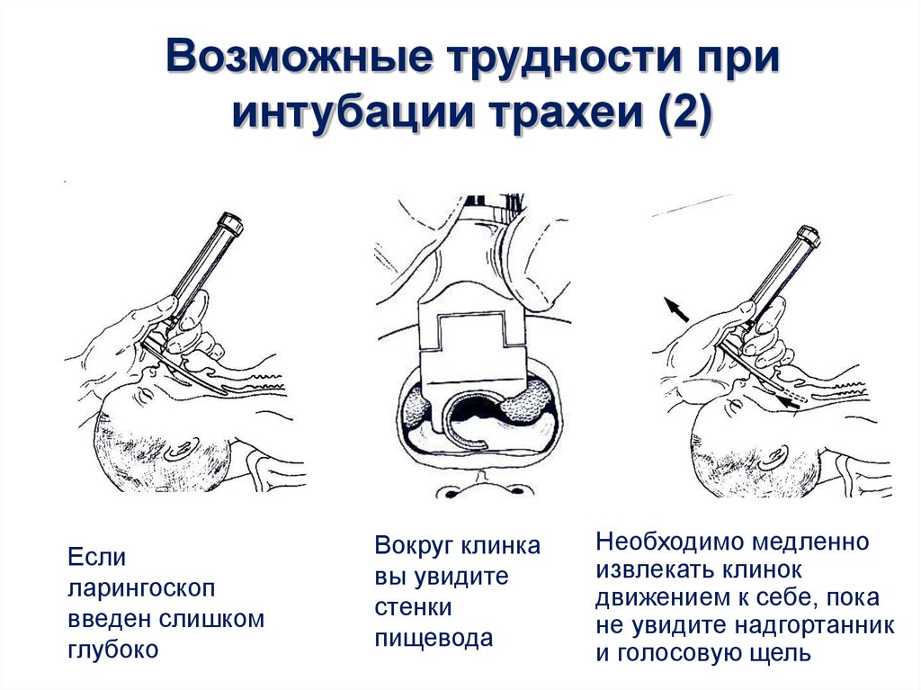 Интубация трахеи картинки