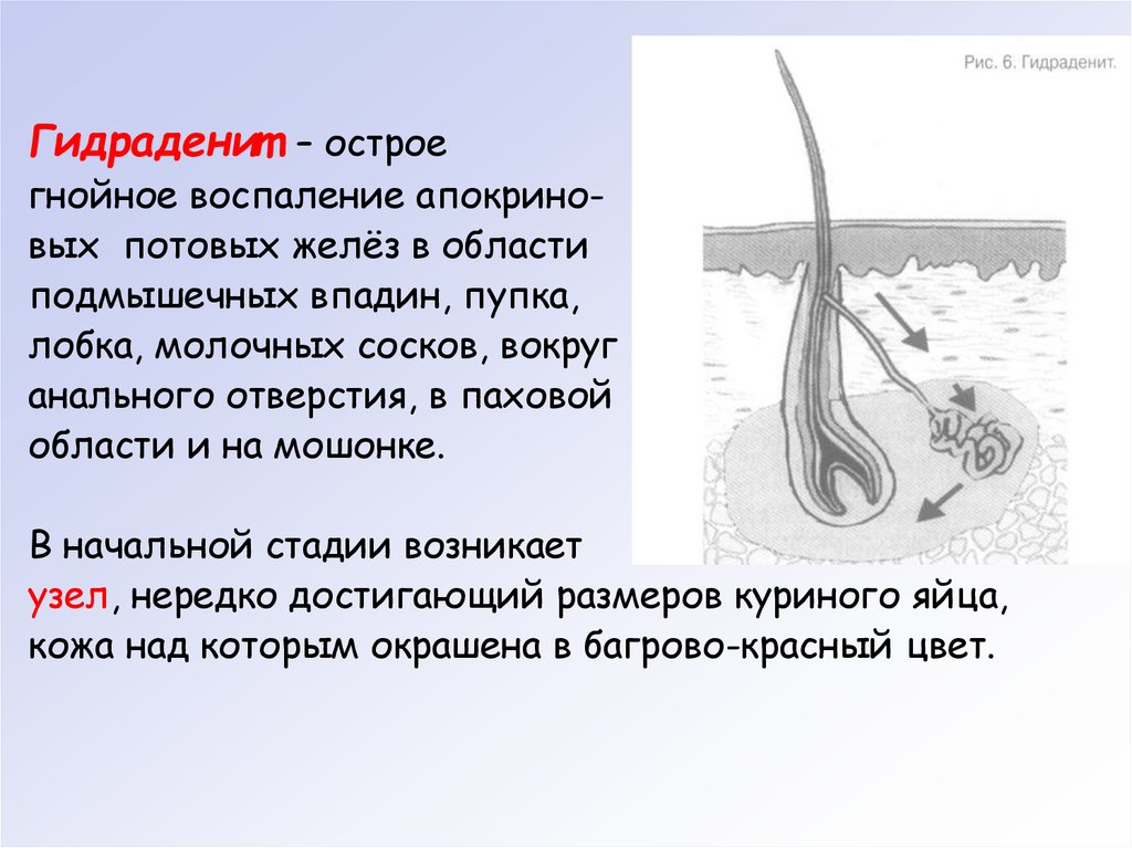 Воспаление желез у женщин. Острый Гнойный гидраденит. Гнойное воспаление апокриновых потовых желез. Гидраденит – это гнойное воспаление:. Гидраденит потовой железы.