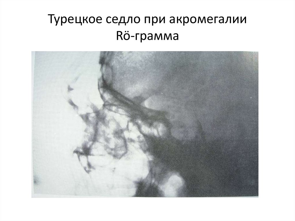 Турецкое седло. Рентген турецкого седла при акромегалии. Турецкое седло закрытого типа. Зона турецкого седла.