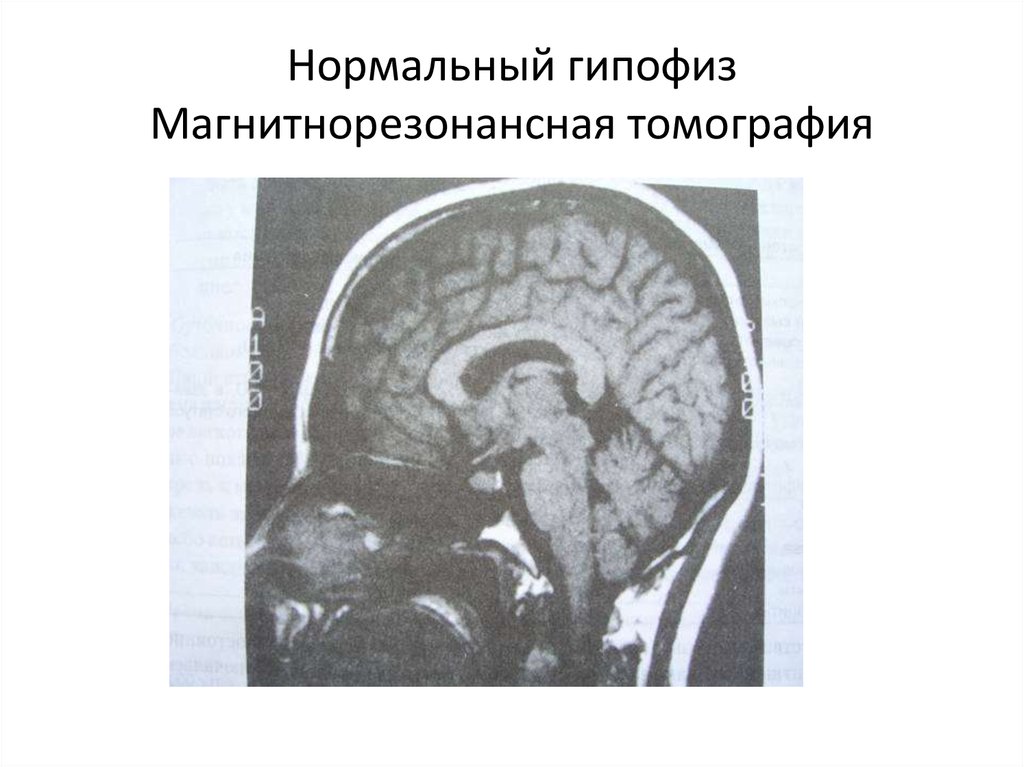 27 нормально. Нормальный гипофиз мрт. Злокачественная опухоль гипофиза. Норма гипофиза. Злокачественная опухоль гипофиза симптомы у женщин.