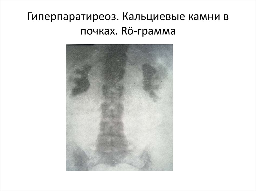 Гиперпаратиреоз патофизиология презентация