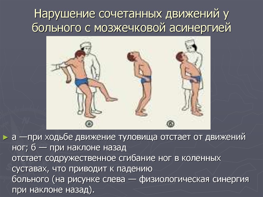 Нарушение движения. Асинергия Бабинского. Мозжечковая асинергия. Нарушение функций мозжечка. Движения туловища.