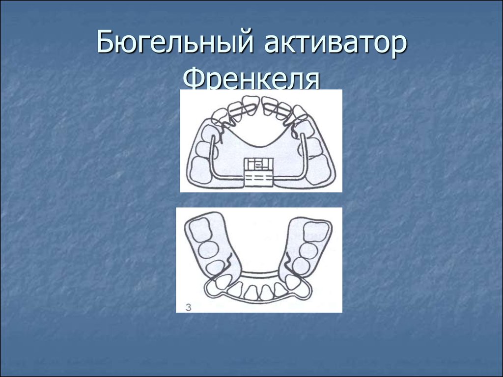 Регулятор функций 1 типа. Регулятор Френкеля ортодонтия. Френкель 2 типа ортодонтия.