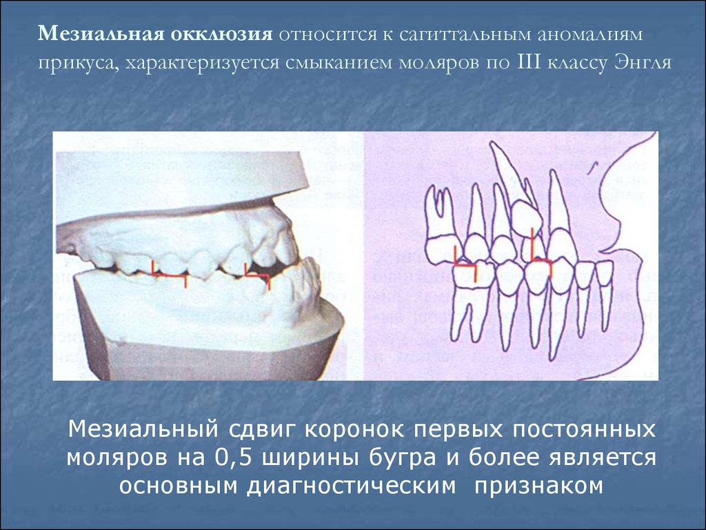 Мезиальная окклюзия презентация ортодонтия