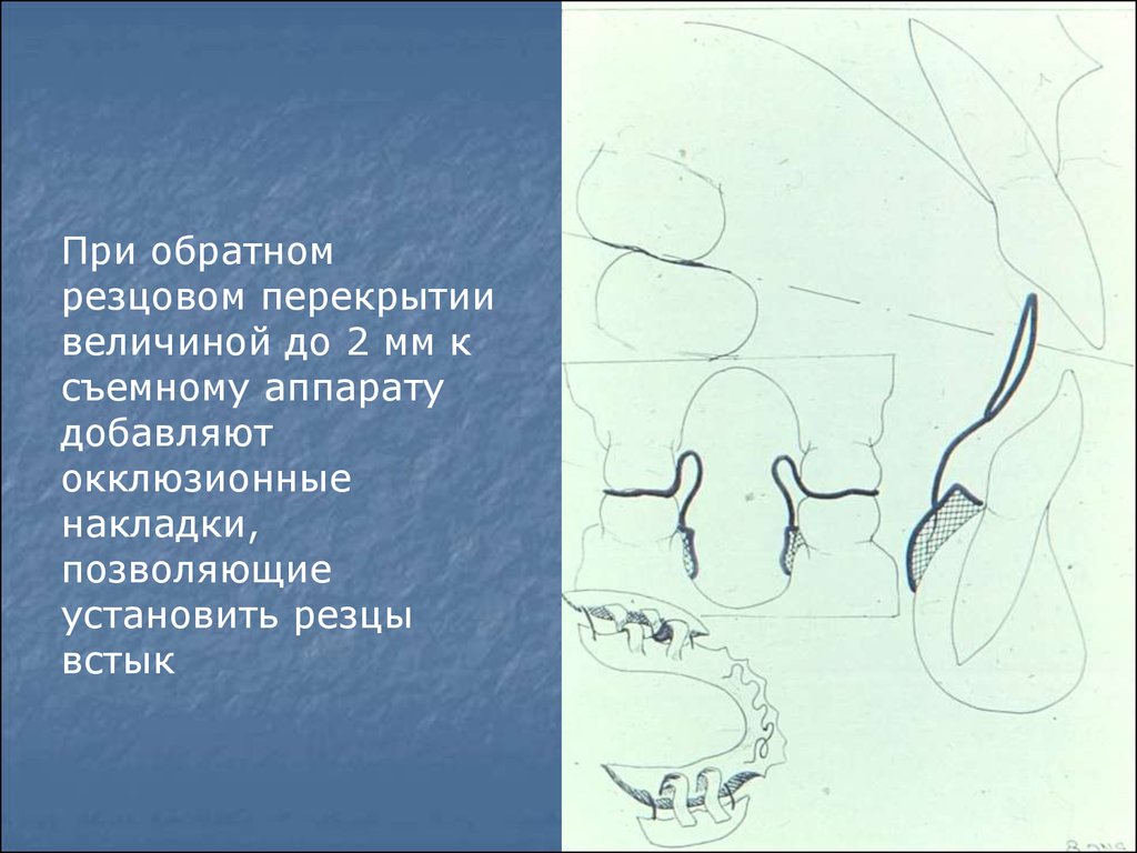 Мезиальный прикус презентация