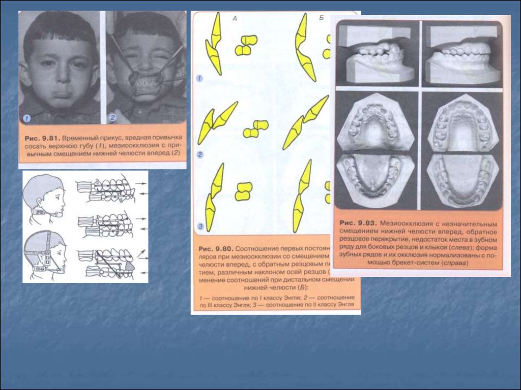 Мезиальный прикус презентация