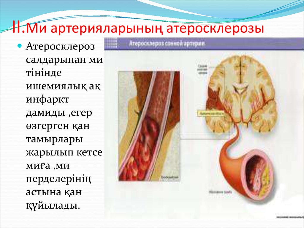 II.Ми артерияларының атеросклерозы