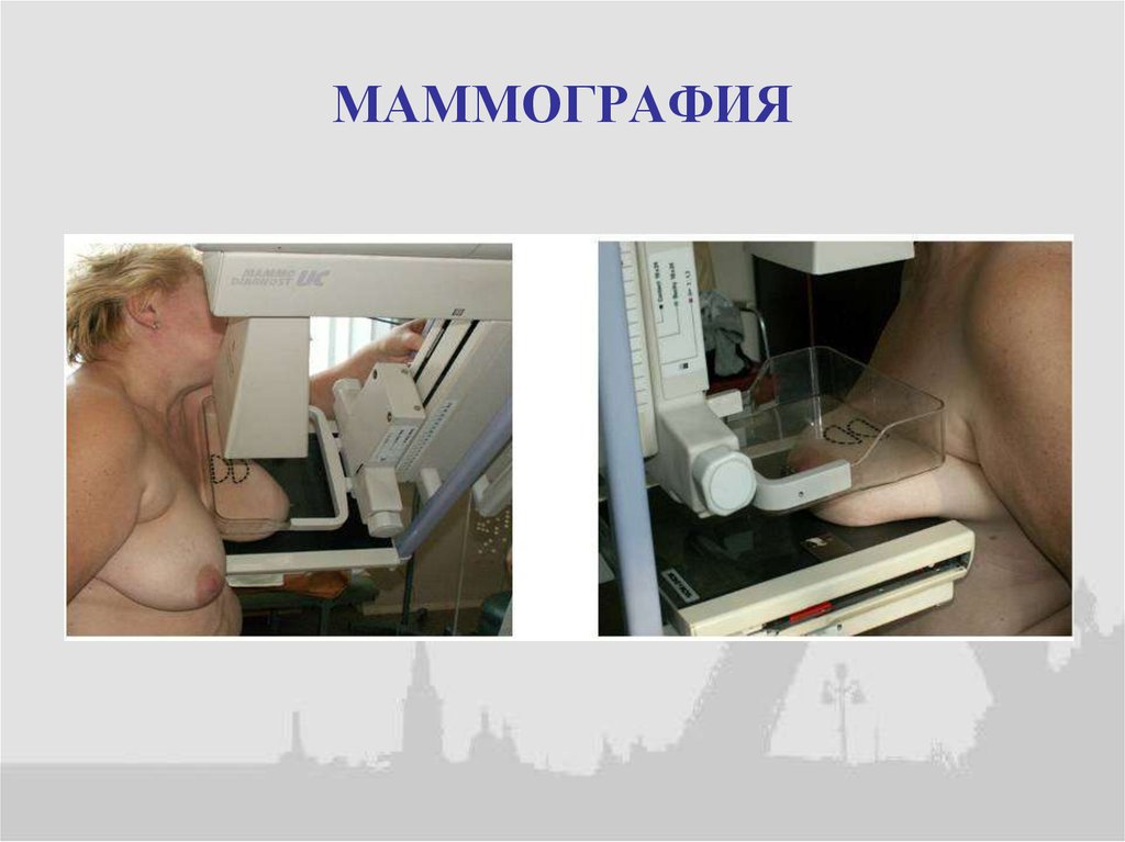 МАММОГРАФИЯ