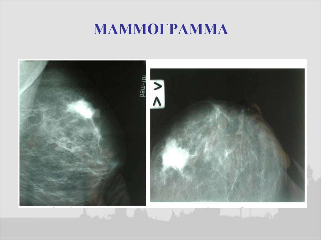 Маммограмма как часто. Маммограмма. Маммография снимки с расшифровкой. Педжета болезнь маммограмма.