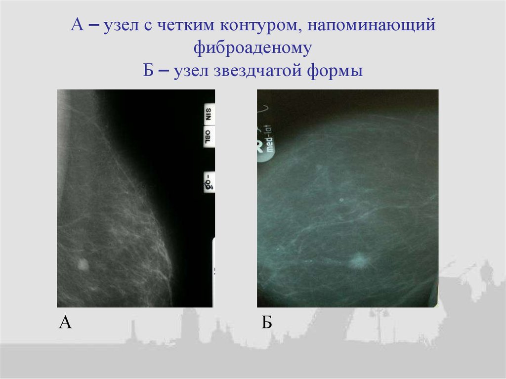 Четкие контуры фиброаденомы