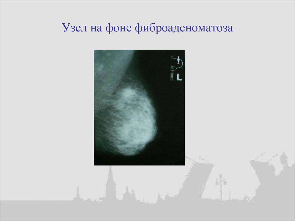 Узел на фоне фиброаденоматоза