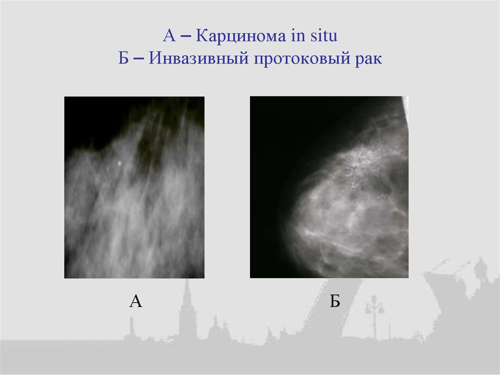 Инвазивный рак молочной железы. Протоковая карцинома молочной железы на УЗИ. Инвазивный протоковый карцинома молочной железы. Протоковая карцинома in situ молочной железы. Протоковый «рак на месте».