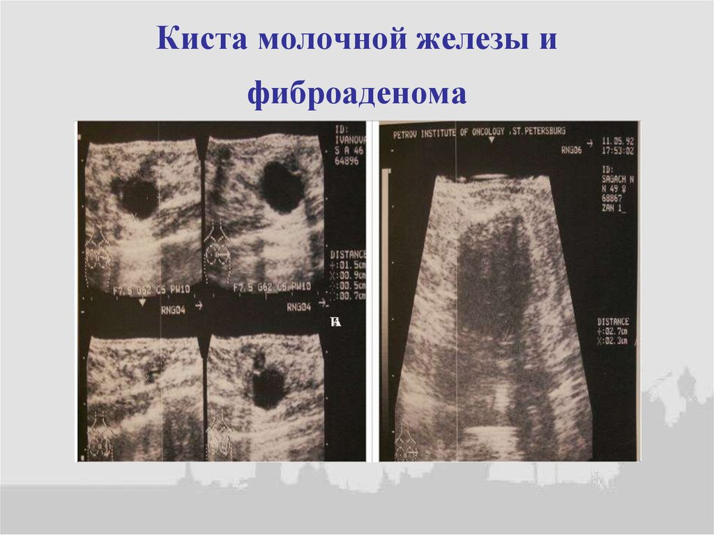 Киста молочной железы и фиброаденома