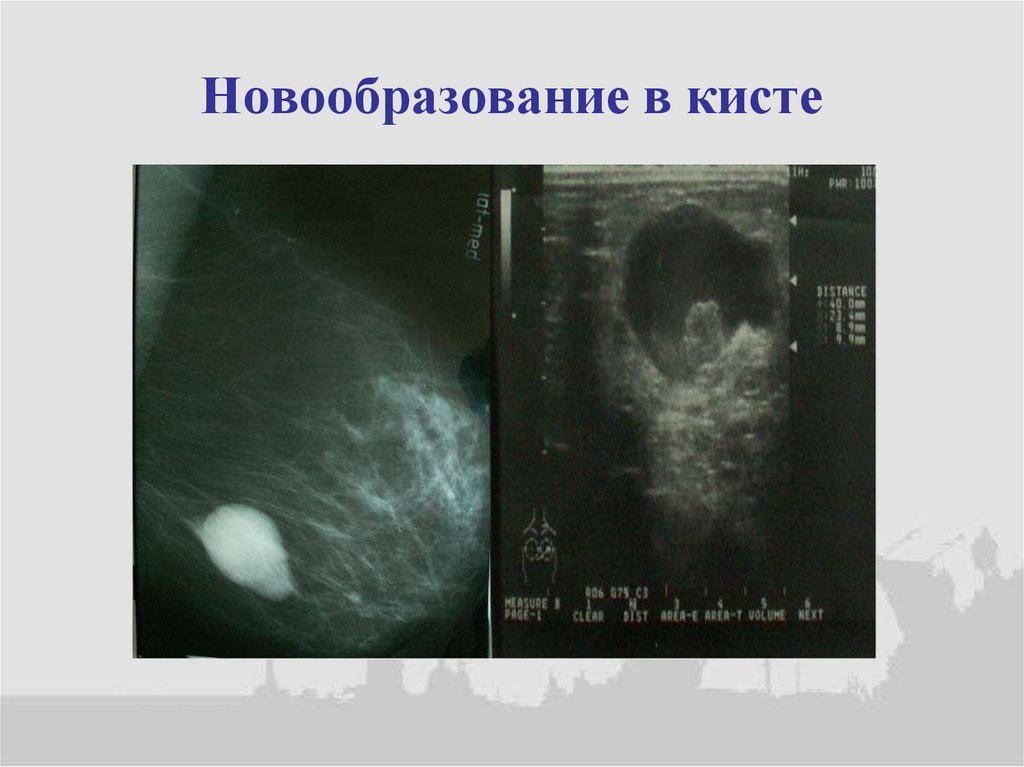 Новообразование в кисте