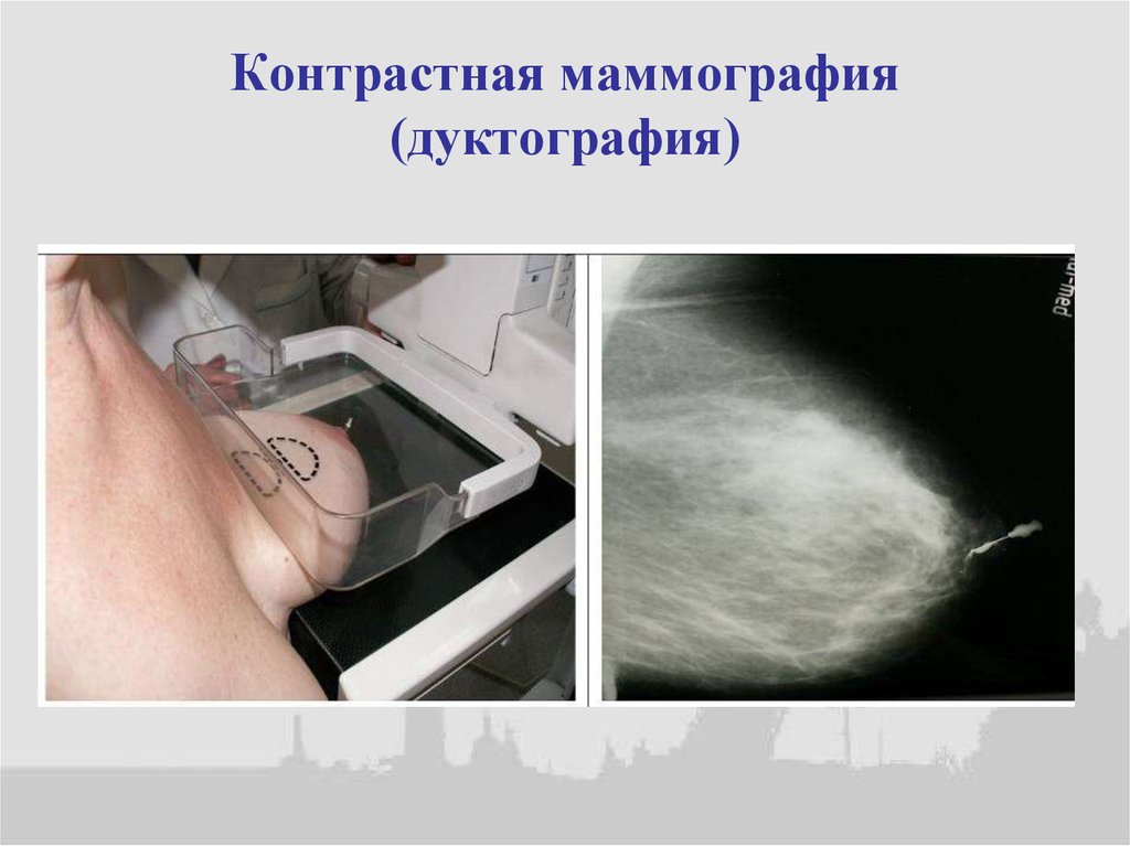 Маммография проекции. Аксиальная проекция маммография. Маммография укладки. Маммография дуктография.