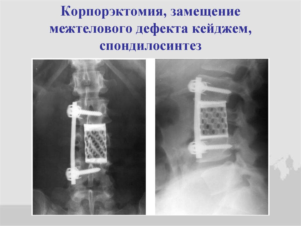 Корпорэктомия, замещение межтелового дефекта кейджем, спондилосинтез