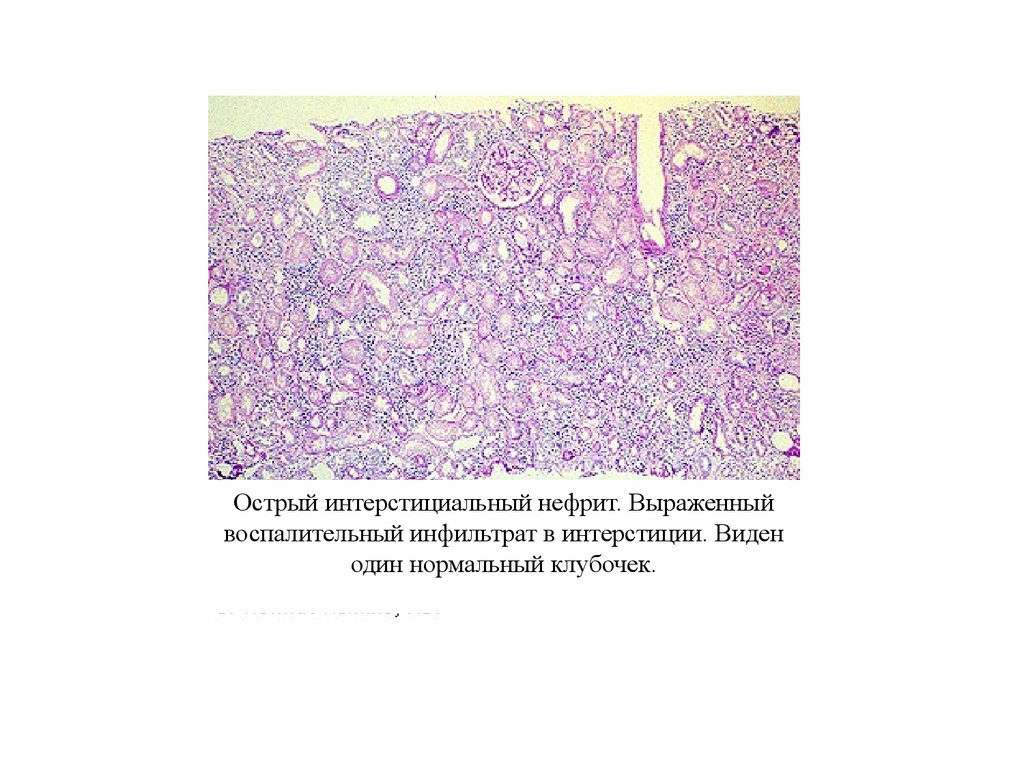 Описание микропрепарата. Острый тубулоинтерстициальный нефрит гистология. Интерстициальный нефрит патанатомия. Межуточный нефрит патанатомия. Межуточный нефрит микропрепарат.