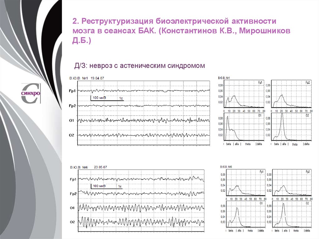 Легкие нарушения биоэлектрической активности. Виды биоэлектрической активности. Биоэлектрическая активность. Неорганизованная биоэлектрическая активность мозга. Бак процедура для мозга.