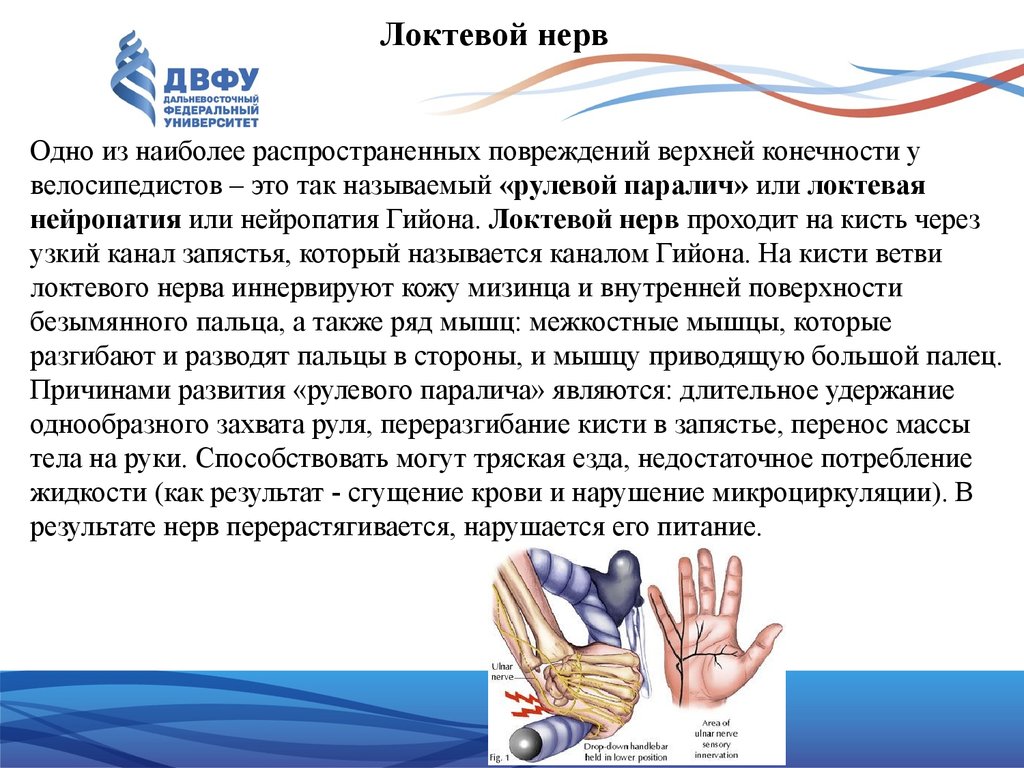 Нейропатия локтевого мкб. Нейропатия локтевого нерва. Нейропатиия блоковогонерва.