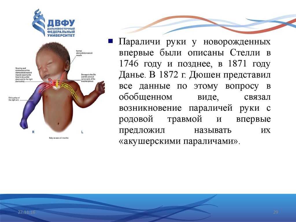 Парез дюшена эрба это. Акушерский паралич Эрба Дюшена. Парез руки у новорожденного. Парез Эрба у новорожденных. Акушерский паралич возникает при.