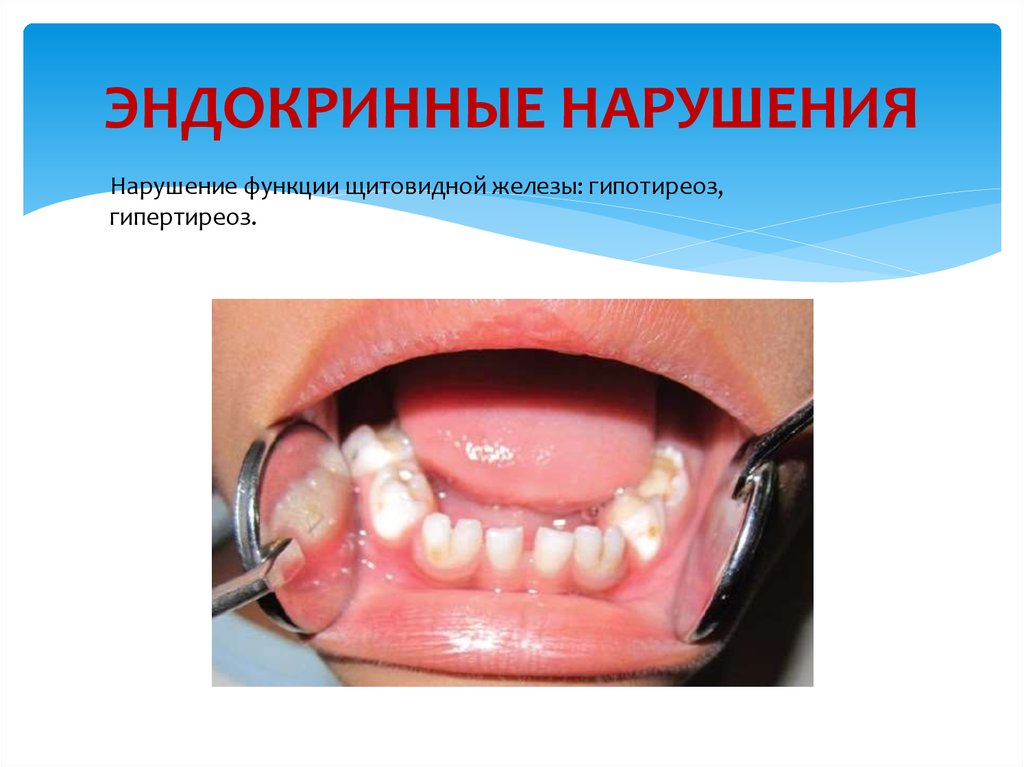 ЭНДОКРИННЫЕ НАРУШЕНИЯ