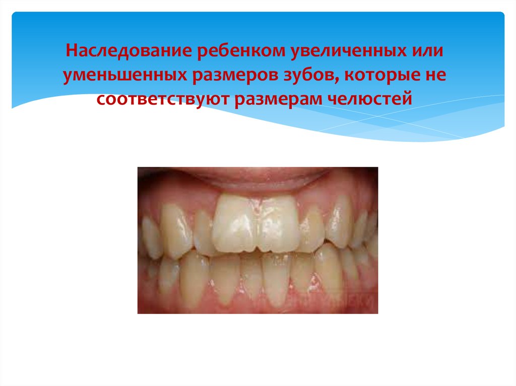 Наследование ребенком увеличенных или уменьшенных размеров зубов, которые не соответствуют размерам челюстей
