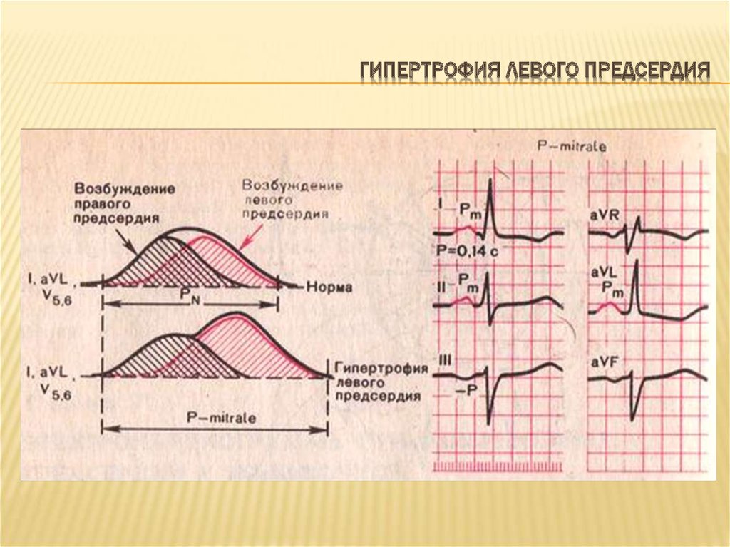 Схема гипертрофия левого желудочка