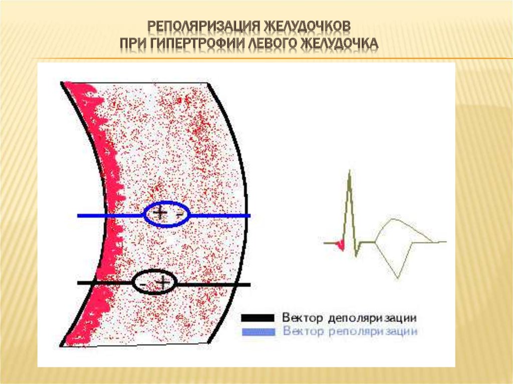 Реполяризация левого. Реполяризация. Реполяризация миокарда желудочков. Деполяризация и реполяризация миокарда. Реполяризация при гипертрофии левого желудочка.