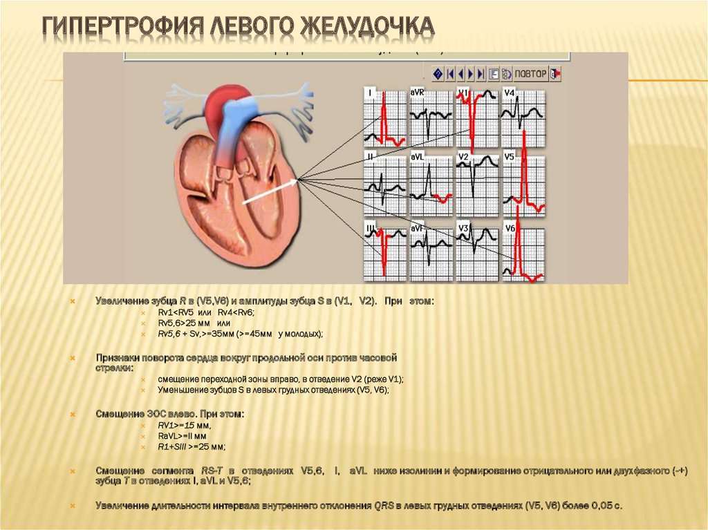 Глж сердца. Гипертрофия левого желудочка при артериальной гипертензии. Гипертрофия миокарда левого желудочка препарат. Гипертрофия миокарда левого желудочка риск 3. Гипертония миокарда левого желудочка сердца.