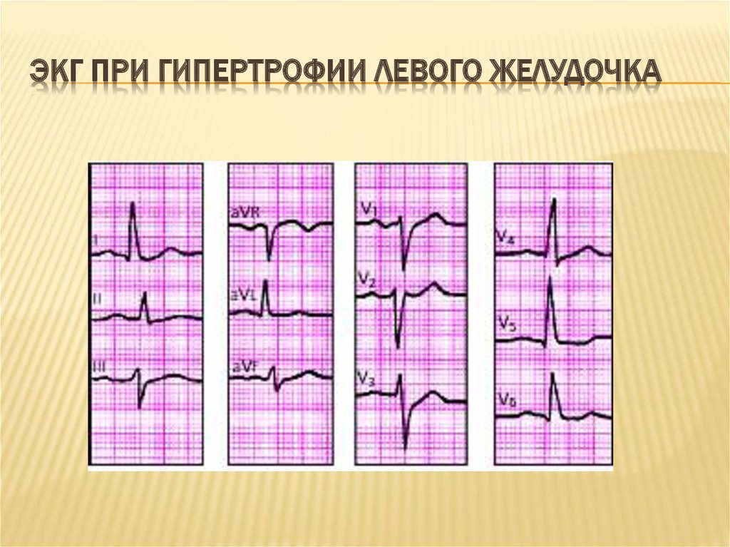 Схема гипертрофия левого желудочка