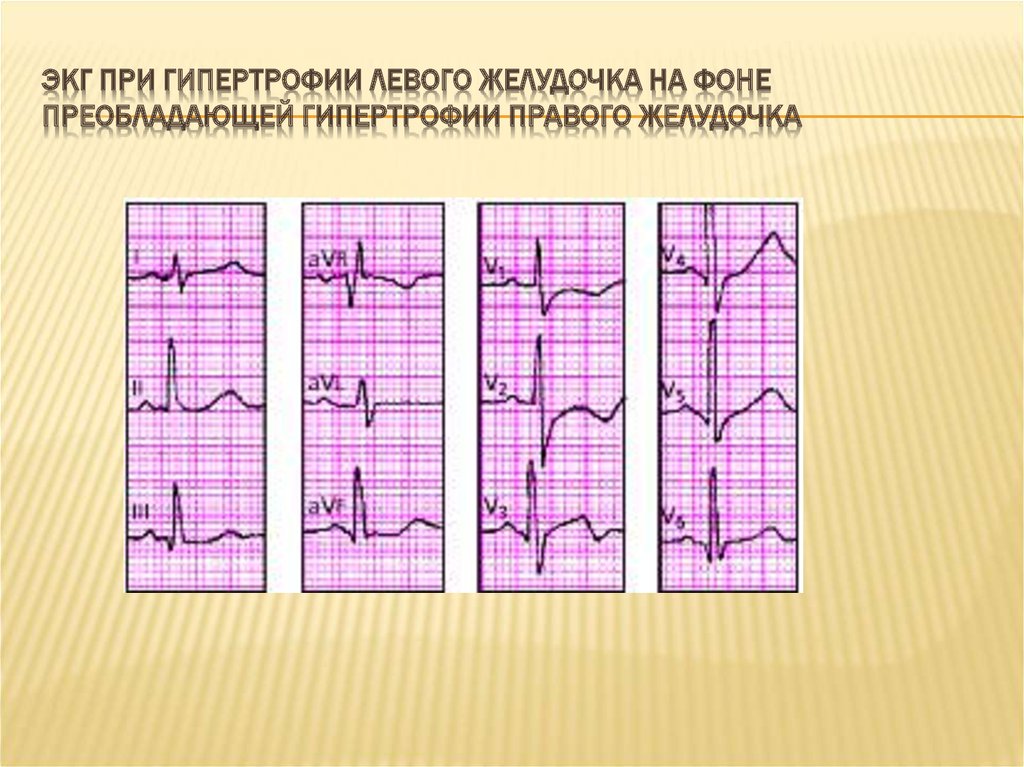 Гипертрофия левого желудочка экг фото