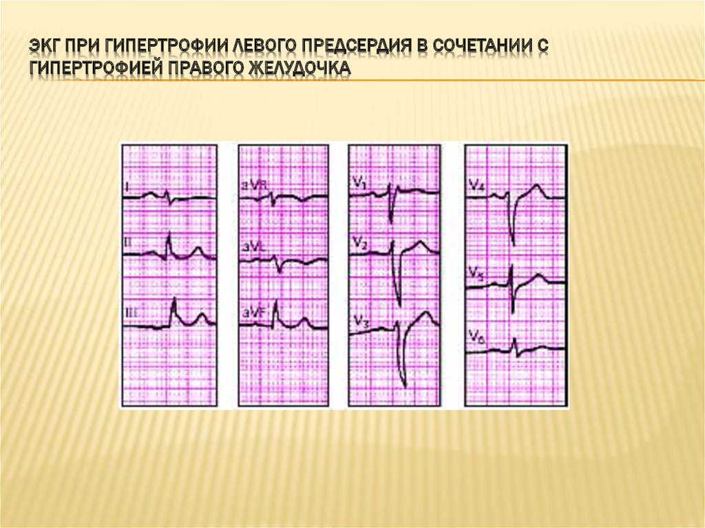 Признаки гипертрофии левого. Гипертрофия левого предсердия на ЭКГ. ЭКГ при гипертрофии миокарда. ЭКГ при гипертрофии миокарда левого предсердия:. ЭКГ при гипертрофии лж.