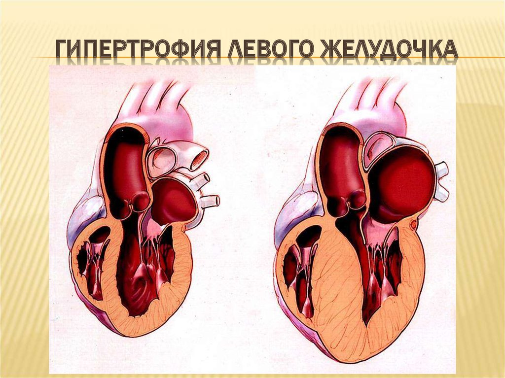 Гипертрофия миндалин у ребенка фото