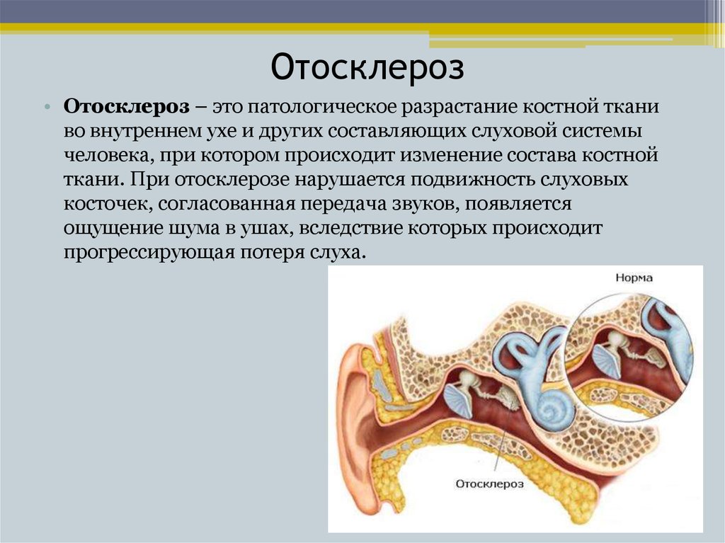 Болезнь внутреннего уха. Фенестральный отосклероз. Болезнь ушей отосклероз. Кондуктивный отосклероз. Отосклероз слухового прохода.