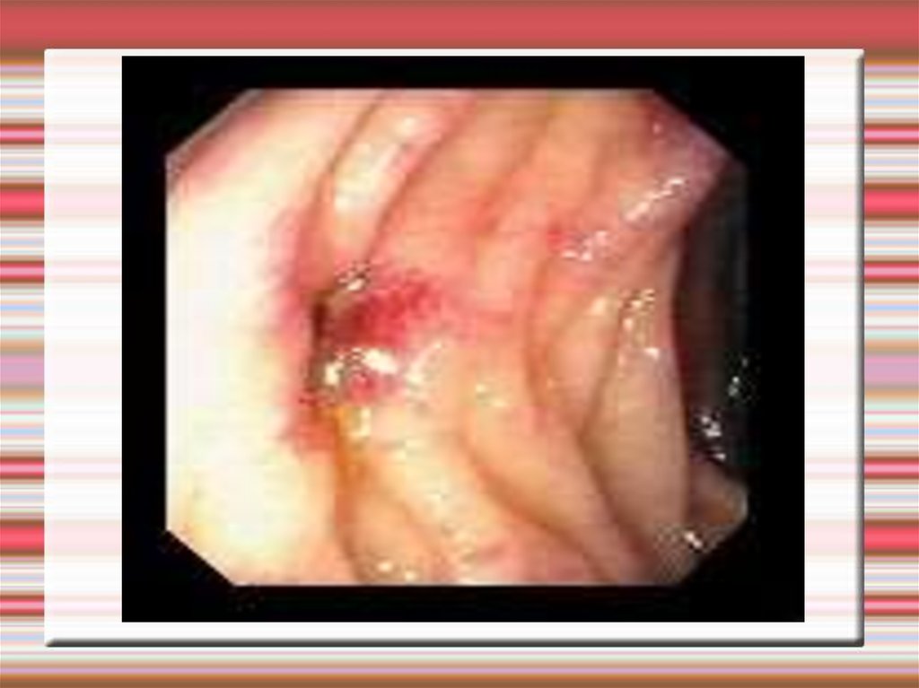 Осложнения дивертикулеза толстой кишки